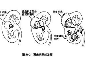 尿路结石