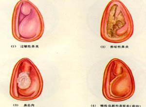 粘膜萎缩