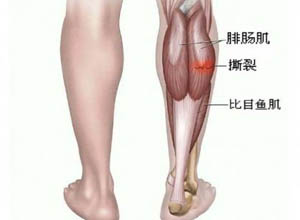 腓肠肌撕裂