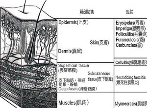 皮下深部筋膜进行性坏死性感染