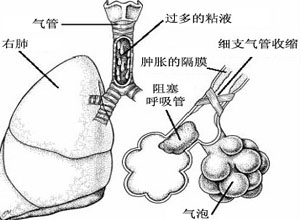 气管受压