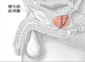 前列腺结石