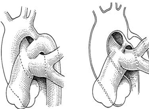 长段升主动脉发育不全
