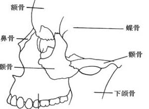 颧骨额骨下陷