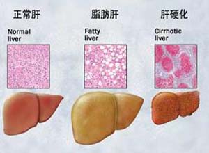 妊娠期急性脂肪肝