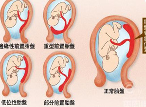 妊娠时伴有腹痛的阴道流血