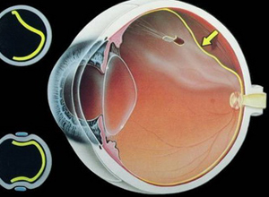 视网膜脱离