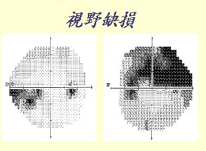 视野缺损