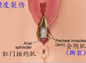 外阴损伤
