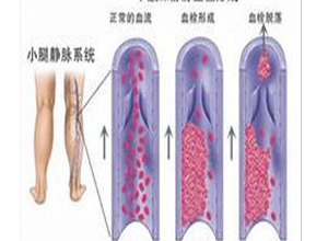 下腔静脉血栓形成