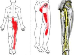 下肢放射痛