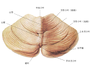 小脑出血