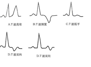 心电图异常