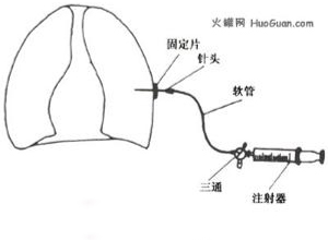 胸膜休克