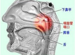 咽鼓管堵塞
