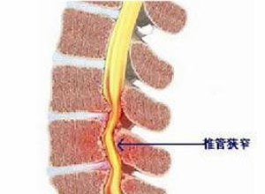 腰椎椎管狭窄