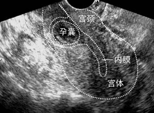 子宫呈葫芦状