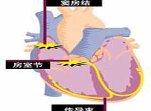 窦房结病变